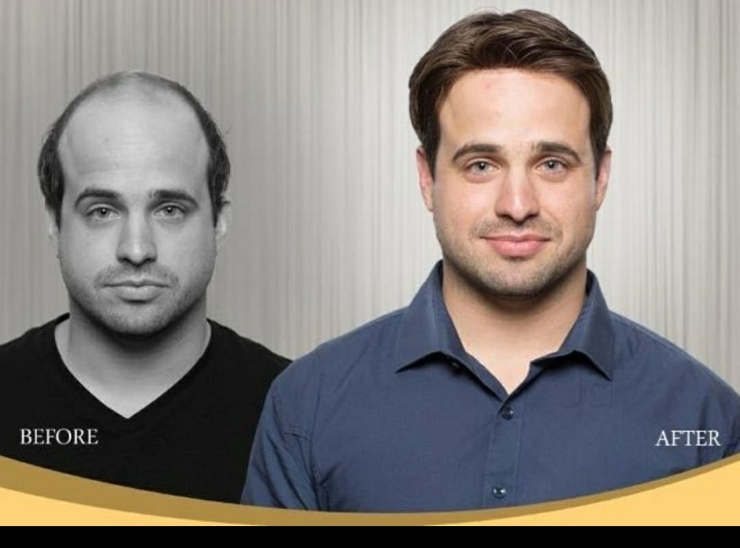 why choose non surgical hair replacement system ?