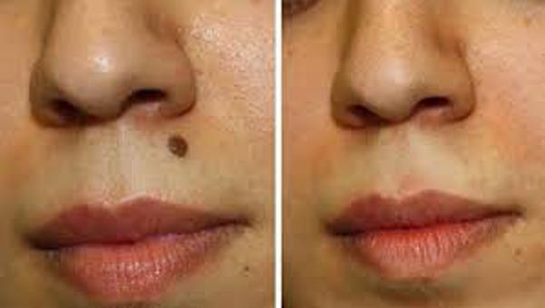 Mole Removal