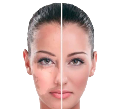 Vitiligo / White Spot