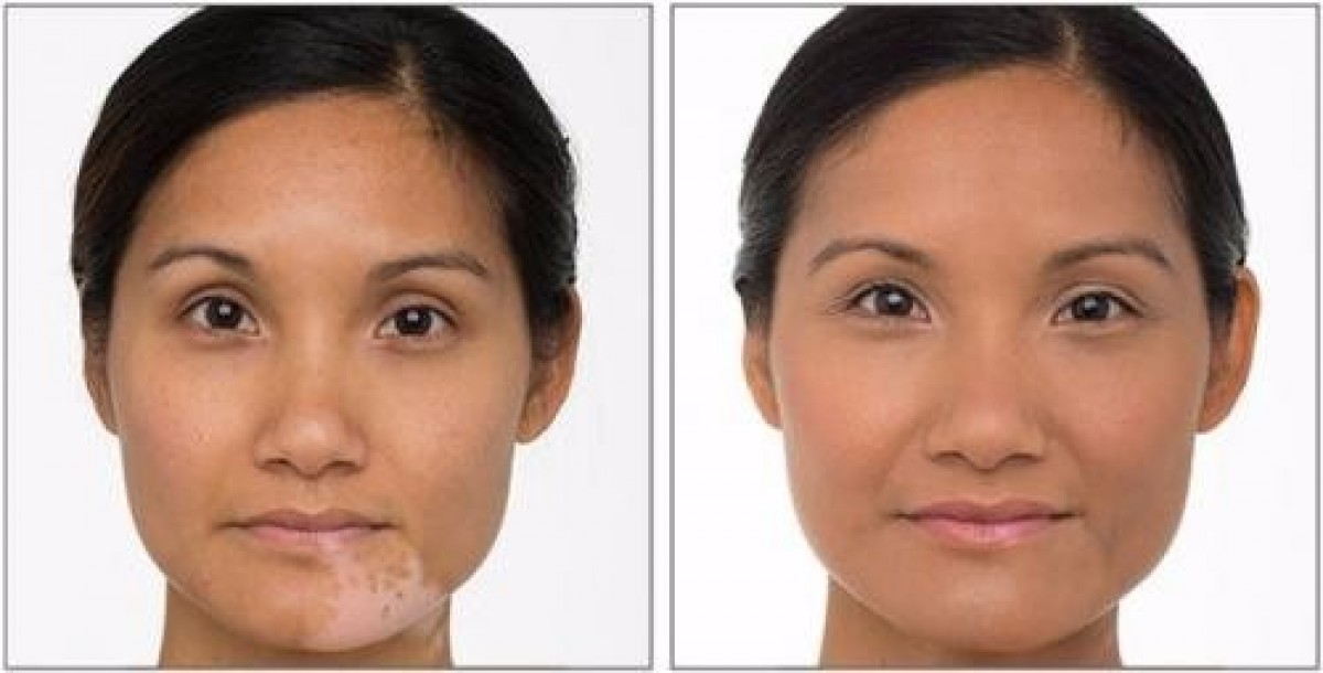 Vitiligo / White Spot