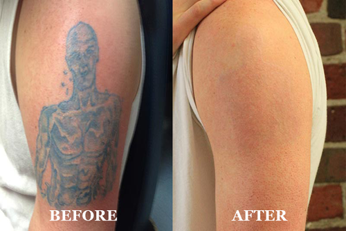 Laser Tattoo Removal